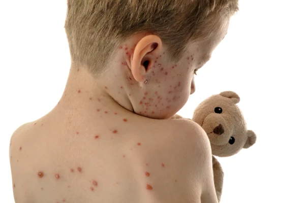 Image for article titled Measles: Are you vaccinated?